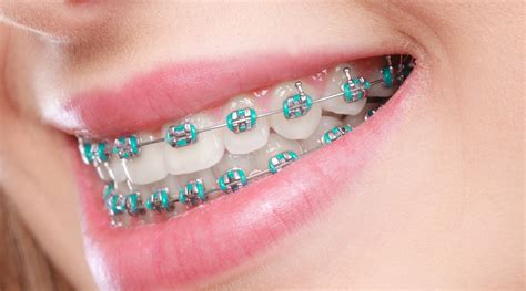 metal braces with color bands